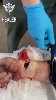 Особенности оказания первой помощи при ранениях кистей рук в зоне боевых действий