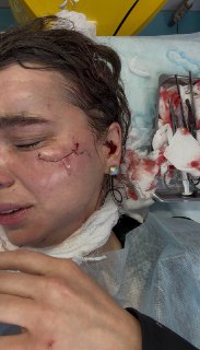 Королеве красоты из Кирова изуродовали лицо в клубе в Казани