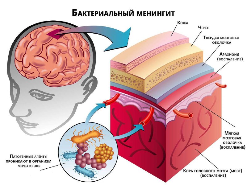 Бактериальный менингит: причины, симптомы и лечение