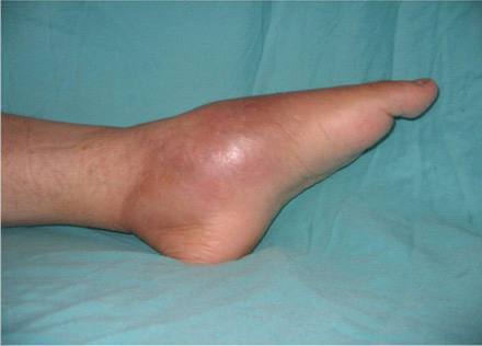 Признаки и первая помощь при остеомиелите в полевых условиях