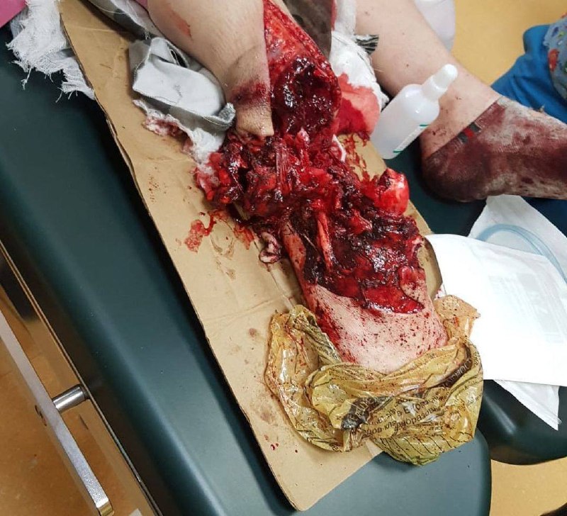 Алгоритм спасения жизни при размозжении конечности в зоне боевых действий