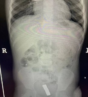 Хирурги извлекли 20 магнитов из кишечника девочки в Подмосковье