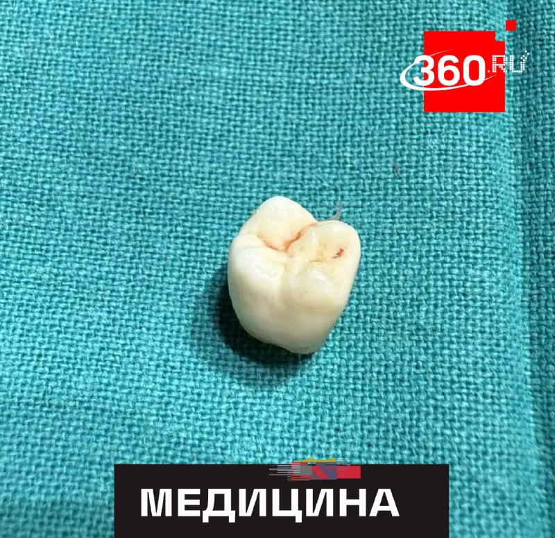 В яичнике девушки в Татарстане обнаружили зуб