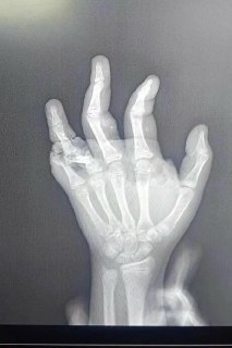 В Липецкой области 13-летняя девочка пострадала после взрыва петарды