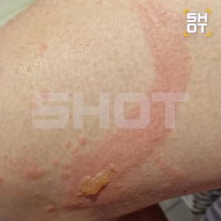 Школьница из Приморья получила химические ожоги во Вьетнаме из-за сока лайма и солнца