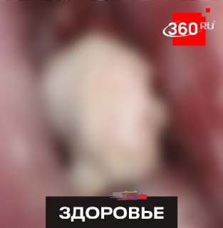 Нижегородские врачи извлекли залежи пломб из гайморовых пазух пациента