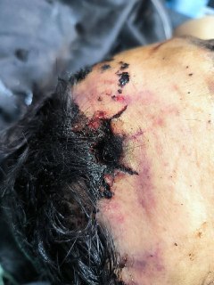 Разбор видов черепно-мозговых травм и особенностей их лечения в зоне СВО