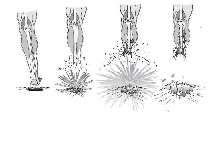 Тактическая медицина: оказание помощи при травматической ампутации